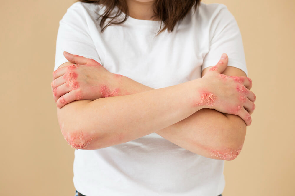 Can Eczema be Cured? Causes, Symptoms and Treatment