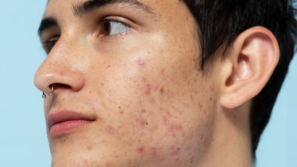 can acne scars be removed